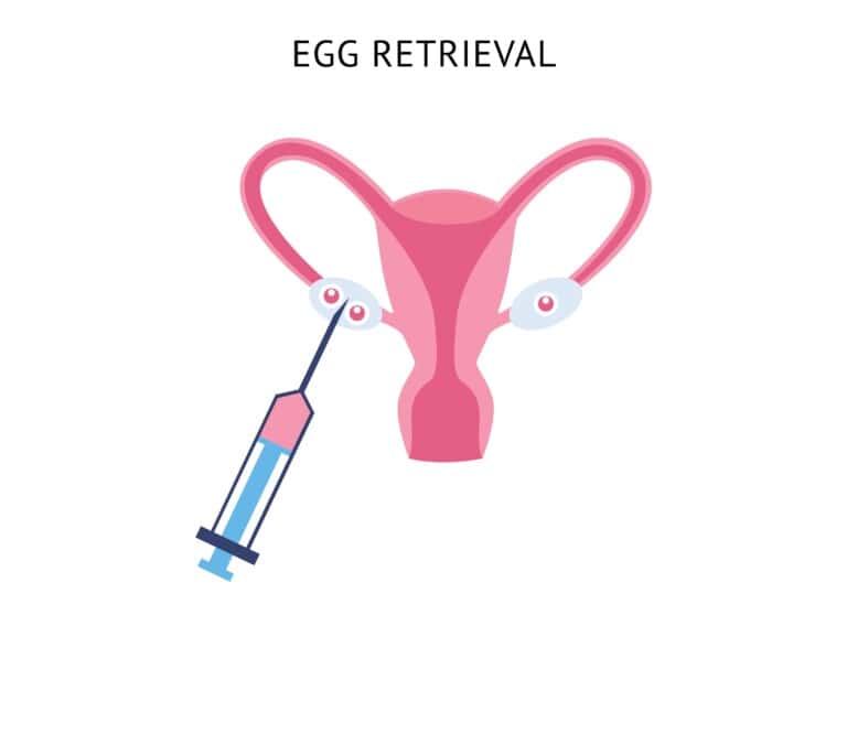Ovum pick-up procedure in IVF where mature eggs are collected from the ovaries