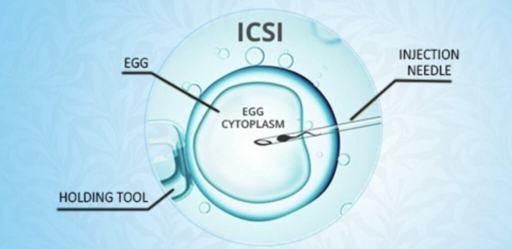 Intracytoplasmic Sperm Injection (ICSI)