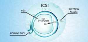 Step-by-Step ICSI Procedure: Cost, Success Rate, Risks & IVF Guide